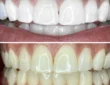 Can a normal dentist do teeth whitening?