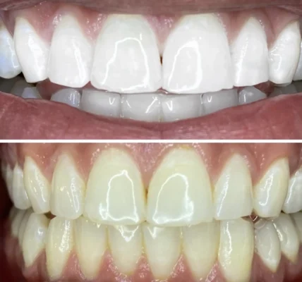 Can a normal dentist do teeth whitening?