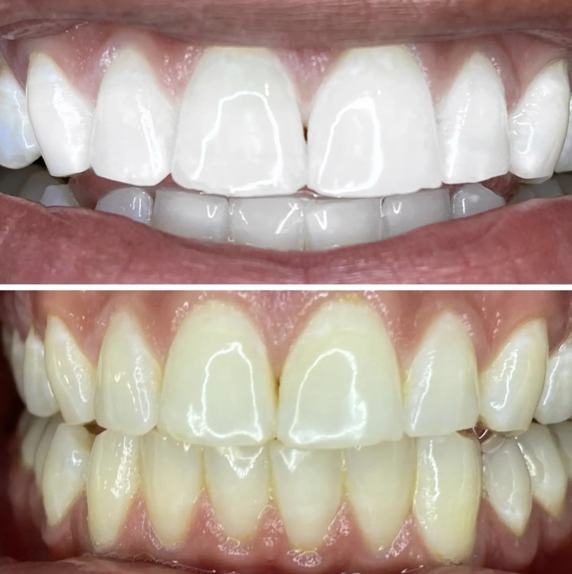 Can a normal dentist do teeth whitening?